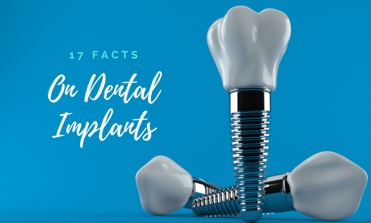 17 facts about dental implants